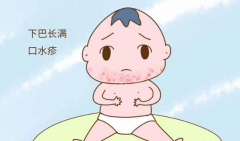 七彩虹水养护小课堂------如何护理宝宝的口水疹